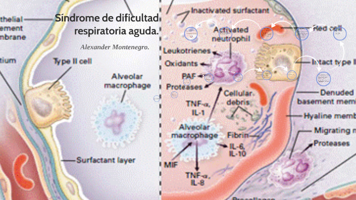 Síndrome De Dificultad Respiratoria Aguda. By Alexander Montenegro On Prezi