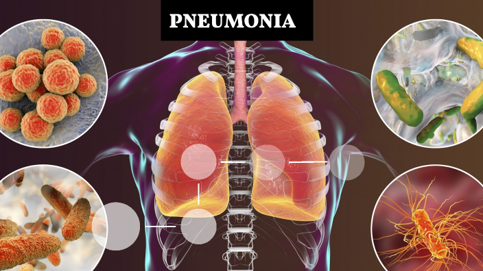 PNEUMONIA by isabella rosa on Prezi