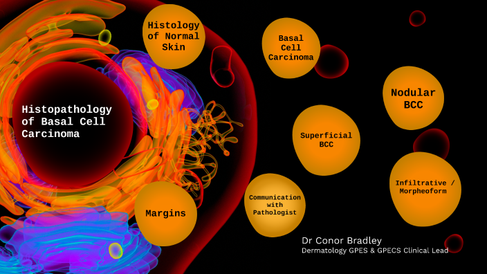 HIstopathology of Basal Cell Carcinoma by Conor Bradley on Prezi