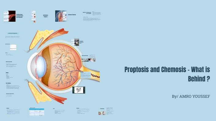 Granulomatosis with Polyangiitis: Proptosis and Ocular Manifestations ...