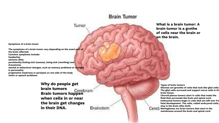 Brain Tumor By Omar Badawy On Prezi