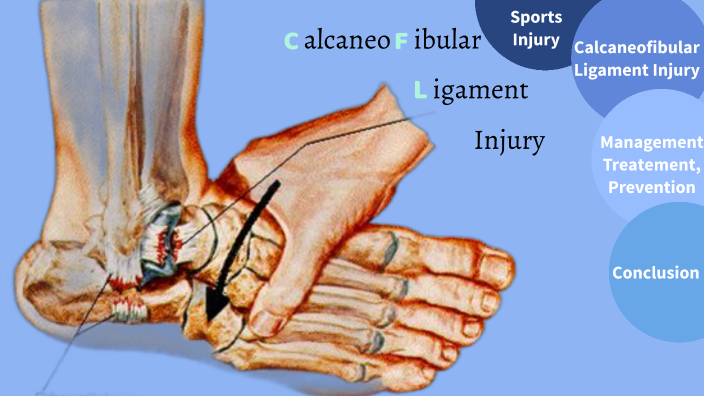 Calcaneofibular Ligament Injury by Ruby Lane on Prezi