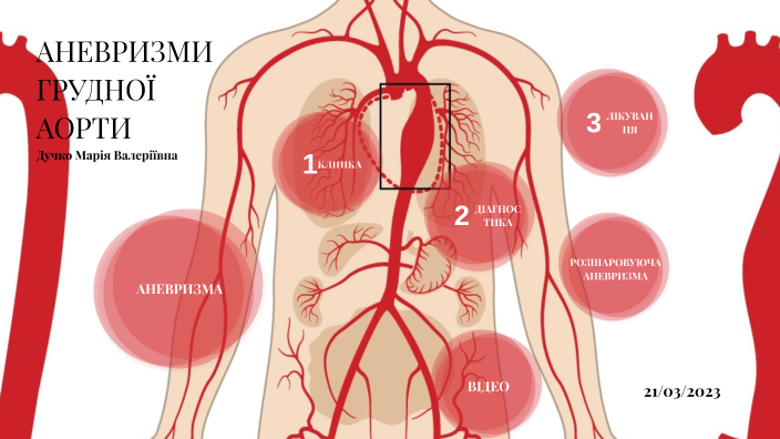 ГРУДНА АНЕВРИЗМА СЕРЦЯ by Maria Duchko on Prezi