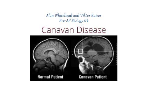 Canavan Disease by Alan Victor