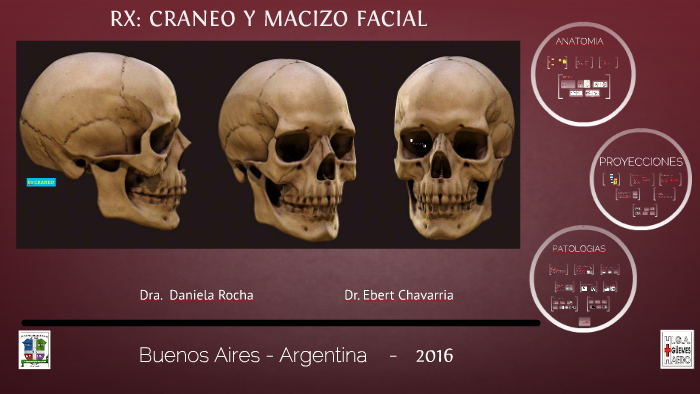 Fractura frontal del hueso del cráneo