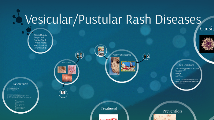 Vesicular Pustular Rash Diseases By Allison Owings On Prezi