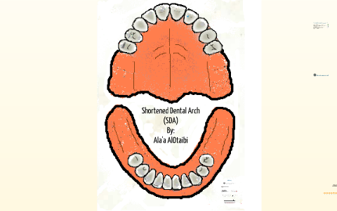 Shortened Dental Arch SDA by Alaa Otaibi on Prezi