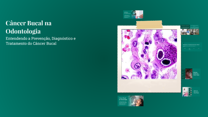 Câncer Bucal na Odontologia by Vitória Araújo Almeida on Prezi