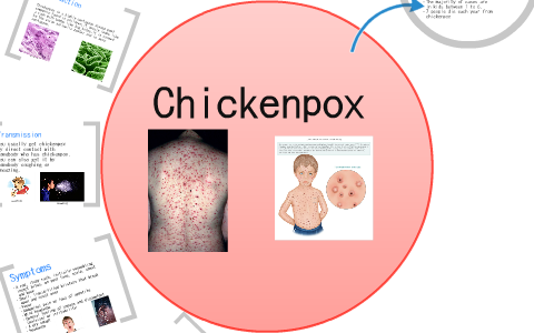 Chicken Pox by Tucker Born on Prezi