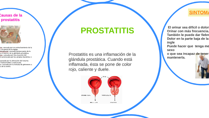 prostatitis és más