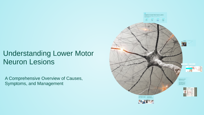 Understanding Lower Motor Neuron Lesions by Anas Oo on Prezi