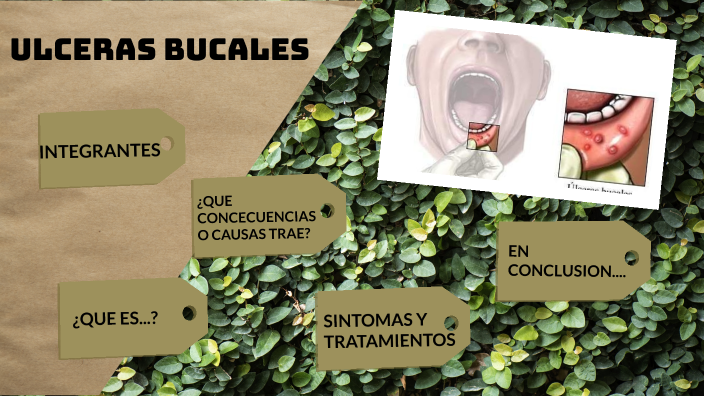 ULCERAS BUCALES by Sheddy Yahir Quispe Copaja on Prezi